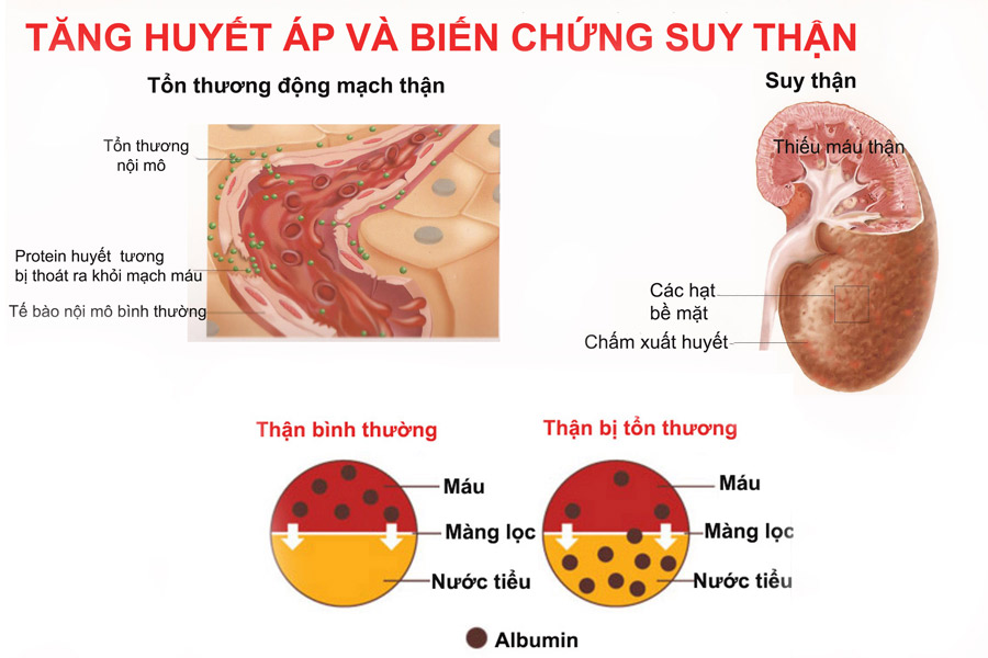 Tăng huyết áp gây biến chứng suy thận