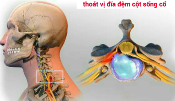 Thoát vị đĩa đệm cột sống cổ