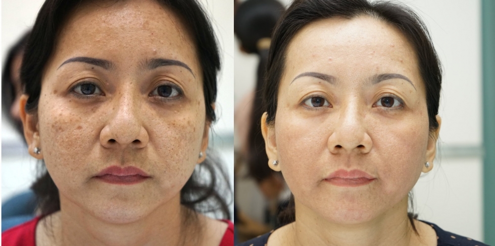 trước và sau khi sử dụng laser 