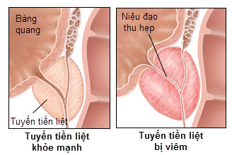 bệnh vêm tiền liệt tuyến
