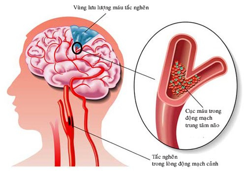 Nguyên nhân chính dẫn đến thiểu năng tuần hoàn não là do xơ vỡ động mạch